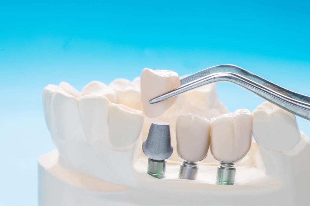 Dental Implants in Jackson Heights and East Elmhurst